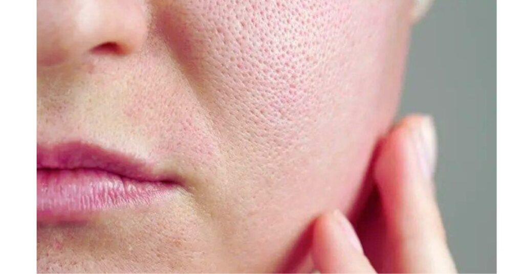 Pores
Fungal Acne 

